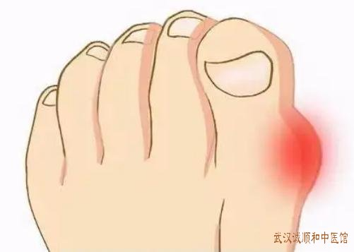 慢性尿酸性肾病